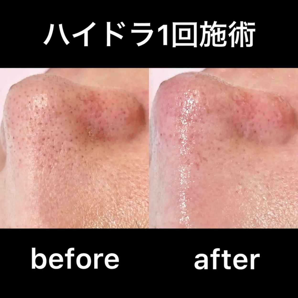 🫧 ハイドラ毛穴洗浄 1回施術🫧